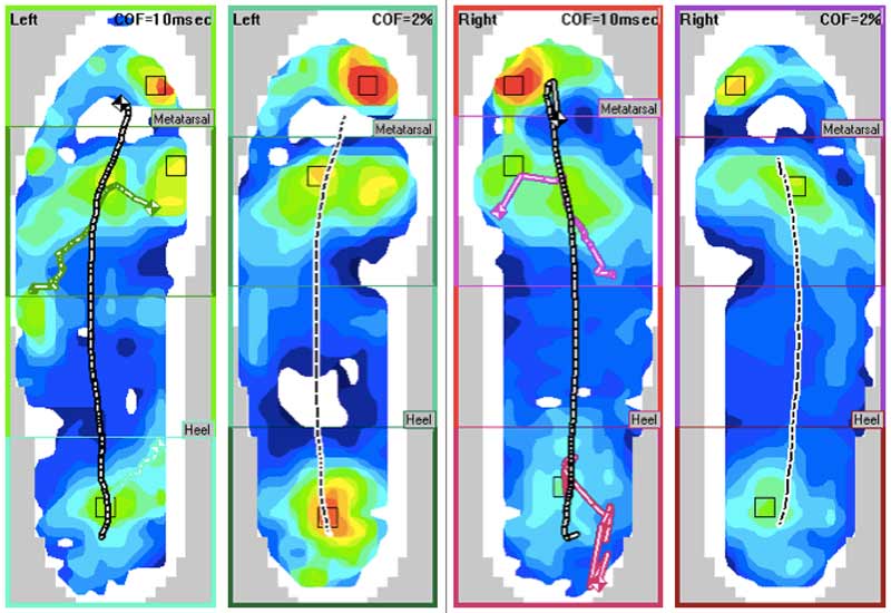 EMG Pressure Mapping