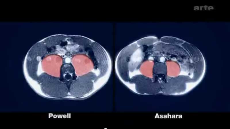 Powell Asahara MRI