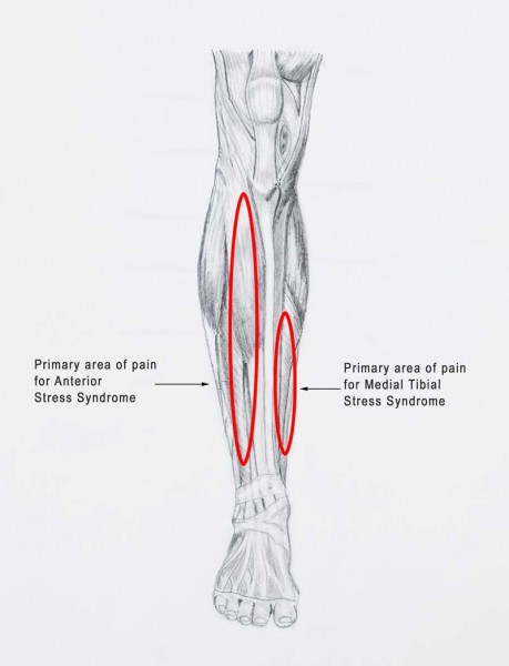 Shin Splints How Smart Coaches Avoid Them Freelap Usa