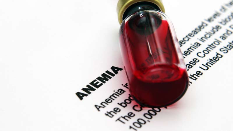 Anemia Iron Deficiancy